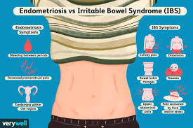 I need to know what caption goes with this picture. The Differences Between Endometriosis And Ibs