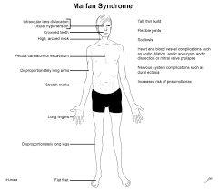 Marfan Syndrome Orthopedics Medbullets Step 2 3