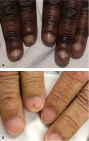 White spots on toenails is quite common among many people. Evaluation Of Nail Abnormalities American Family Physician