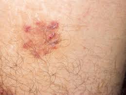Image result for Pemphigus