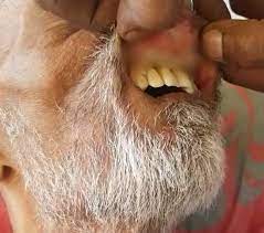 Wait until trash collection day. Family Left Fuming As Maggots Found In Mouth Of Durban Hospital Patient News24