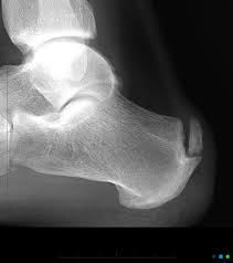 Insertional Achilles Calcific Spur Radiology Case Radiopaedia Org