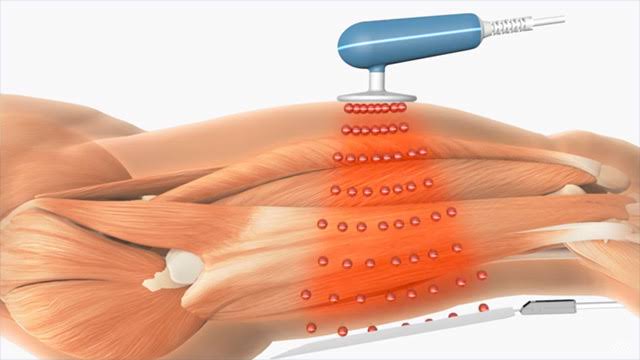 CRET - TECAR THERAPY product image