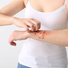 Image result for Monkeypox