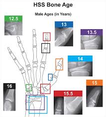 A New Validated Shorthand Method For Determining Bone Age