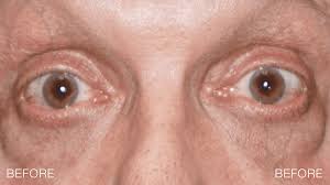 Image result for Entropion