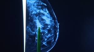 Nnas a nurse, you will have to know how to provide care for these patients and what nursing interventions to include in your nursing plan of care. Breast Cancer Caused By More Than Just Genetics Quiz Helps Women Identify Risk Wcco Cbs Minnesota