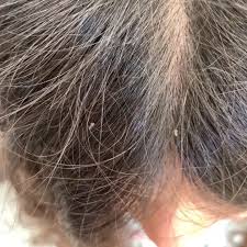 Pin On Who Gets Head Lice