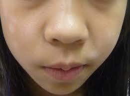 The exact cause is unknown. Hypopigmented Lesions On An 11 Year Old S Face Consultant360