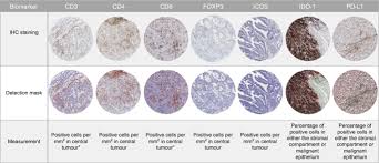 Genomic marker is associated with lynch syndrome, a hereditary cancer condition, across many different cancers. Immune Status Is Prognostic For Poor Survival In Colorectal Cancer Patients And Is Associated With Tumour Hypoxia British Journal Of Cancer