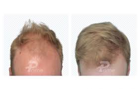 Alibaba.com offers 1,782 hair transplant men products. Calgary S Most Trusted Hair Clinic Hair Transplants Prime Hair Clinic