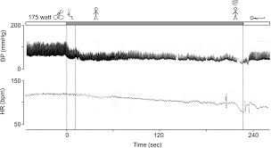 Image result for Exercise Induced Syncope