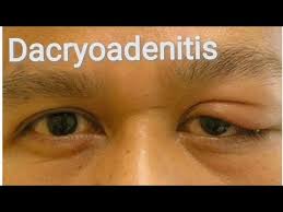 Image result for Dacryoadenitis