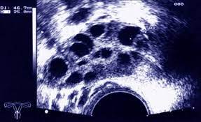 There is no cure for polycystic ovary syndrome, but there are lifestyle and medical treatments to deal with the symptoms. Endokrinologie Lh Spiegel Bei Frauen Mit Pco Syndrom