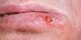 Image result for Lip Cancer