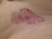 However, it is possibly caused by a preexisting adenoma that becomes malignant there are a number of methods that can be used to detect adrenocortical tumors. Basal Cell Carcinoma Lloyd Dermatology Center