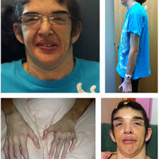 PDF) Dystonia, facial dysmorphism, intellectual disability and breast  cancer associated with a chromosome 13q34 duplication and overexpression of  TFDP1: Case report