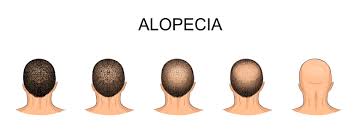 Everything you need to know about Alopecia areata: