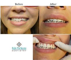 Crowns are often needed to fix badly broken back teeth because the original tooth structure isn't strong enough to take biting pressure any more. Kyle Tx Chipped Tooth Repair Buda Broken Cracked Tooth Restoration