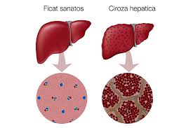 Evolutia de la hepatita cronica la ciroza se face lent, in decursul mai multor ani (de exemplu, evolutia unei hepatite alcoolice in ciroza se face in. Ciroza Hepatica Reginamaria Ro
