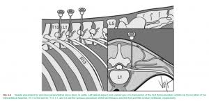 Image result for Intrapleural Anesthesia