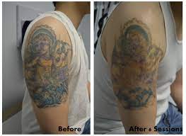 Full Color Tattoo Removal After 6 Sessions Look At That Fading Tattoo Removal Color Tattoo Tattoos