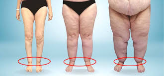 Understanding Lipedema: Causes, Symptoms & Treatment Options | Aesthetic  Appointment