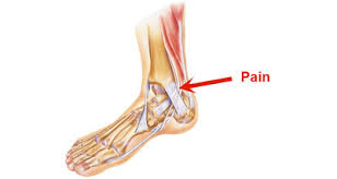 Pain on side of the foot or lateral foot pain can be due to many of possible causes. Inside Foot Pain Symptoms Causes Treatment Rehabilitation
