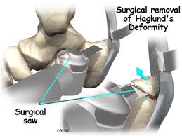 First described by haglund in 1928, a haglund's deformity is an 1 an isolated haglund's deformity can lead to posterior heel pain in runners due to adjacent soft tissue impingement by the heel counter. Haglund S Deformity Of The Foot Orthogate
