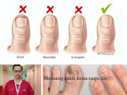 1) adakah cium sebelah atas (kuku) atau perut ibu jari? Potong Kuku Terlalu Pendek Pakai Pula Kasut Sempit Siap Sedialah Kena Cagu Sakitnya Bukan Main Doktor Ini Bagi Cara Rawatannya Remaja