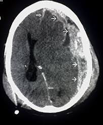 Schadel Hirn Trauma Wikipedia