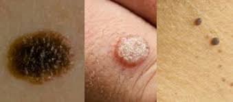 Pyogenic granulomas usually form after an injury to the skin and bleed easily. Is It A Mole A Wart Or A Skin Tag Skin Post