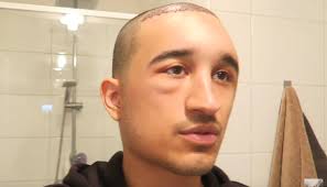 Bekijk hier het vervolg van de haartransplantatie. Nesim Najih Reageert Op Haartransplantatie Video Vertelt Dat Hij Nog Een Operatie Wil Laten Doen En Waarom Axed