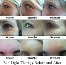 Neutrogena's light therapy acne spot treatment. Red Yellow Light Therapy Seriously Fights Aging Red Light Therapy Light Therapy Light Therapy Mask