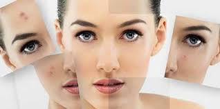 Sivilce Nasil Gecer Sivilceyi Bir Gunde Geciren Limonlu Karisim Magazin Haberleri Milliyet