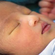 Meskipun penyakit kuning umum terjadi pada bayi baru lahir, kadar bilirubin yang tinggi dan tidak ditangani (secara medis dikenal sebagai hiperbilirubinemia berat) dalam darah dapat menyebabkan bilirubin mengalir ke dalam otak sehingga mengakibatkan komplikasi yang serius. Bayi Anda Kuning Perlukah Waspada
