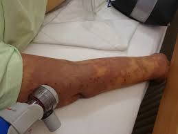 Coli), and some types of streptococcus, so people who have these infections should also be aware of the signs. Do You Know The Signs Of Sepsis Video Highlights The Dangers Of Condition That Cost Fife Gran Her Limbs Edinburgh Live