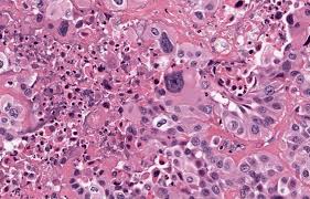 Correlation Cytologique Et Histologique Dans Le Diagnostic Des Nodules Thyroidiens
