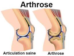 Ursächlich werden ein übermaß an belastung (etwa erhöhtes. Arthrose Definition Docteurclic Com