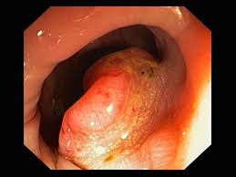 En effet, selon ces scientifiques, appliquer ces trois recommandations en cas de cancer du côlon de stade iii (un. Cancer Colorectal Troubles Digestifs Manuels Msd Pour Le Grand Public