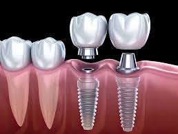 Can I Have a Tooth Inserted on the Day of the Implant? - Dental Estetik  Center