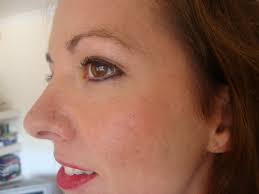 Can i get rid of my cheek piercing scar? Nose Piercing Scars Hypertrophic Scars How To Get Rid Of Nose Piercing Scars Beauty Sight