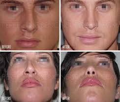 Nose Straightener Pro Deviated Septum Surgery Alternativeperfect Nose Non Surgical Nose Job Alternatives perfect nose straightener pro
