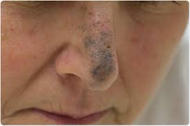 Image result for Blue Nevus
