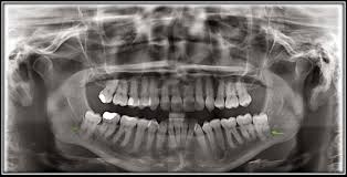 You've probably heard of wisdom teeth, but may not know all that much about them. Wisdom Tooth Extraction Oaktree Dental And Implant