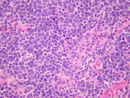It is also known as cutaneous apudoma, primary neuroendocrine carcinoma of the skin, primary small cell carcinoma of the skin, and trabecular carcinoma of the skin. Merkel Cell Carcinoma Pathology Dermnet Nz
