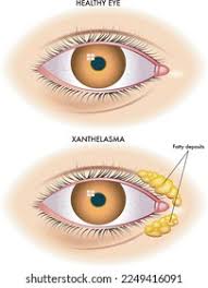 Image result for xantelasma
