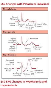 ecg ekg changes in hypokalemia and hyperkalemia medical