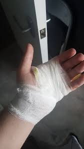 Image result for Hand Injury