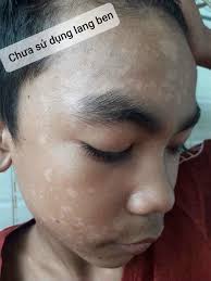 Trị Lang Beng Trên Da Mặt